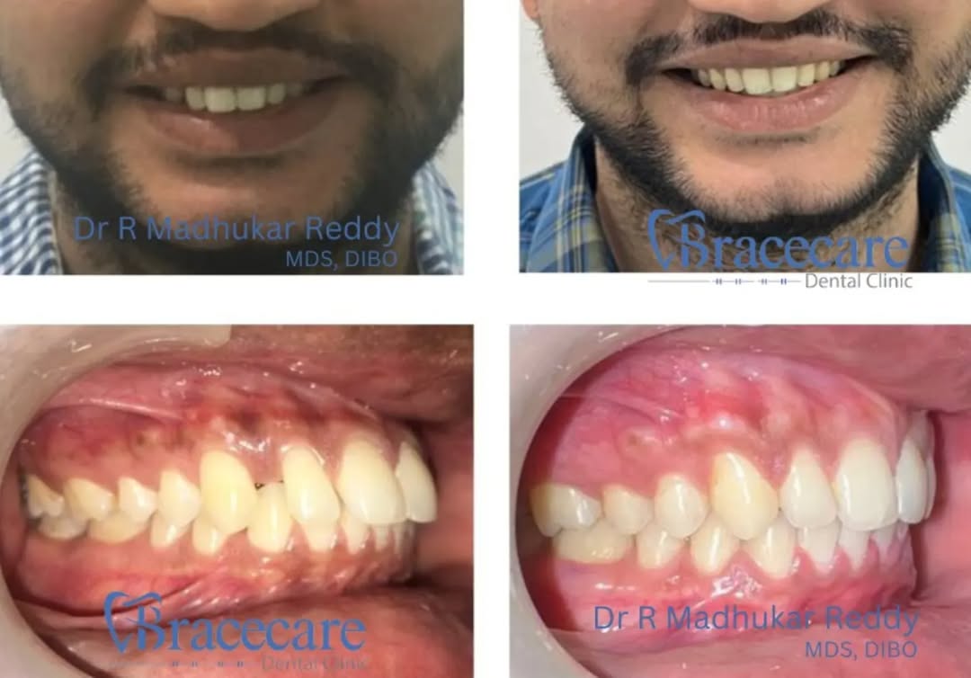 invisalign hyderabad (7)