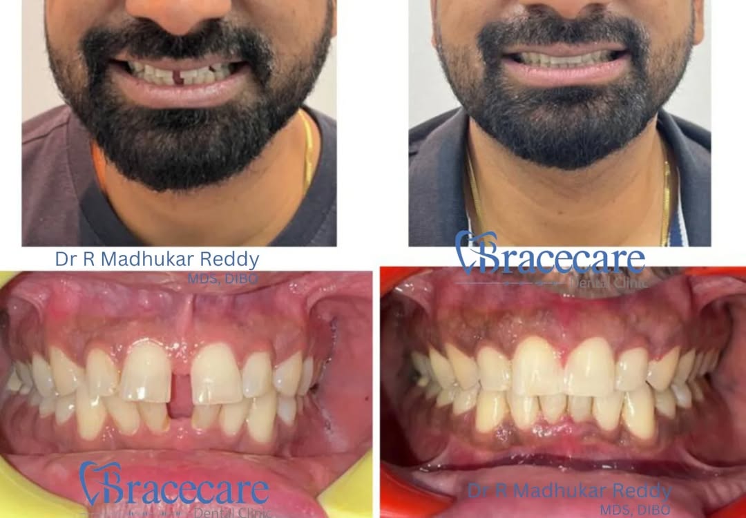 invisalign hyderabad (8)