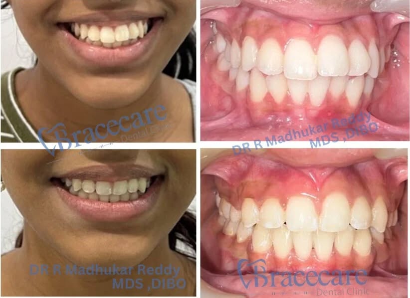 invisalign manikonda (6)